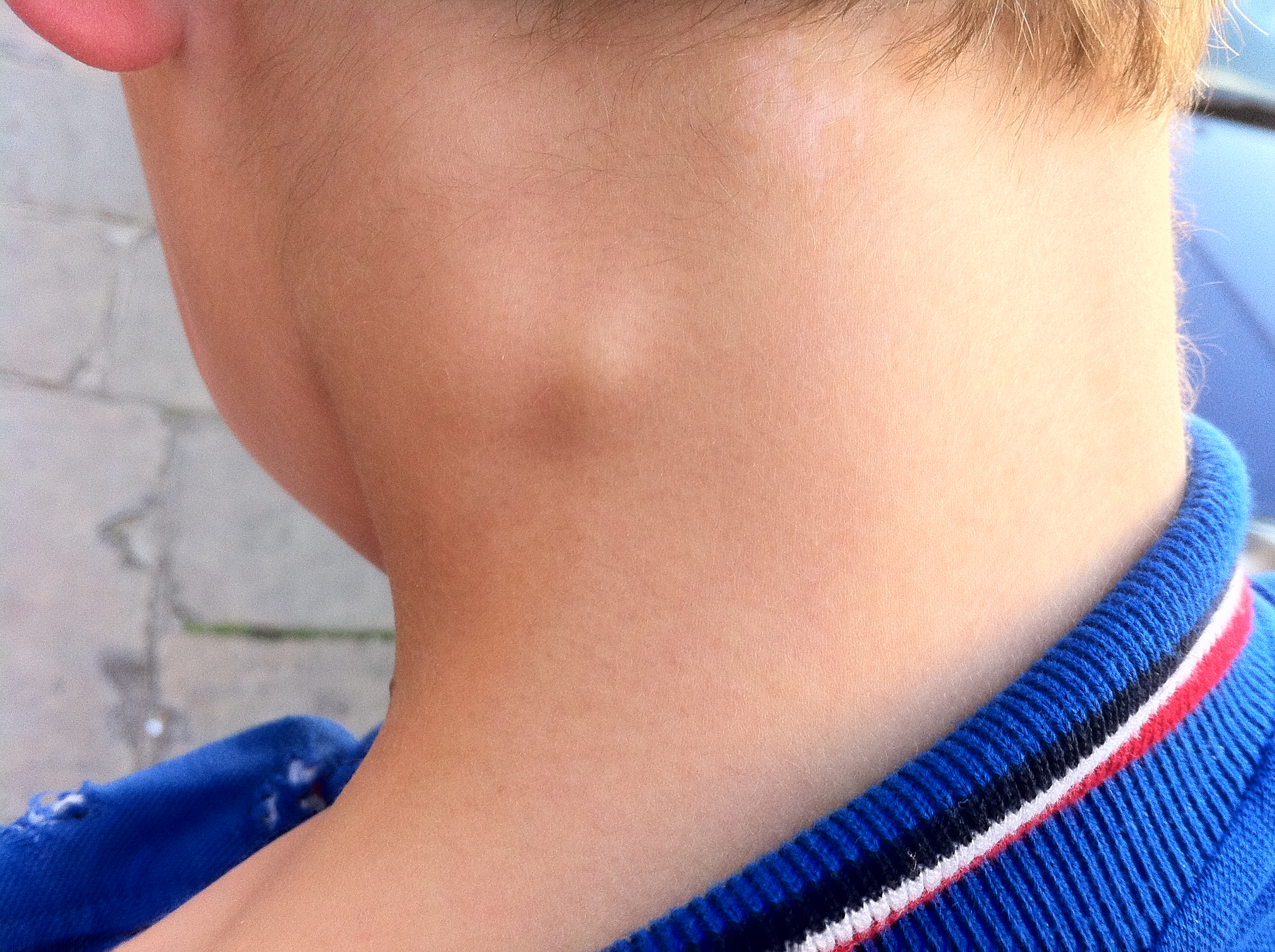 Lymph Node Lump On Neck